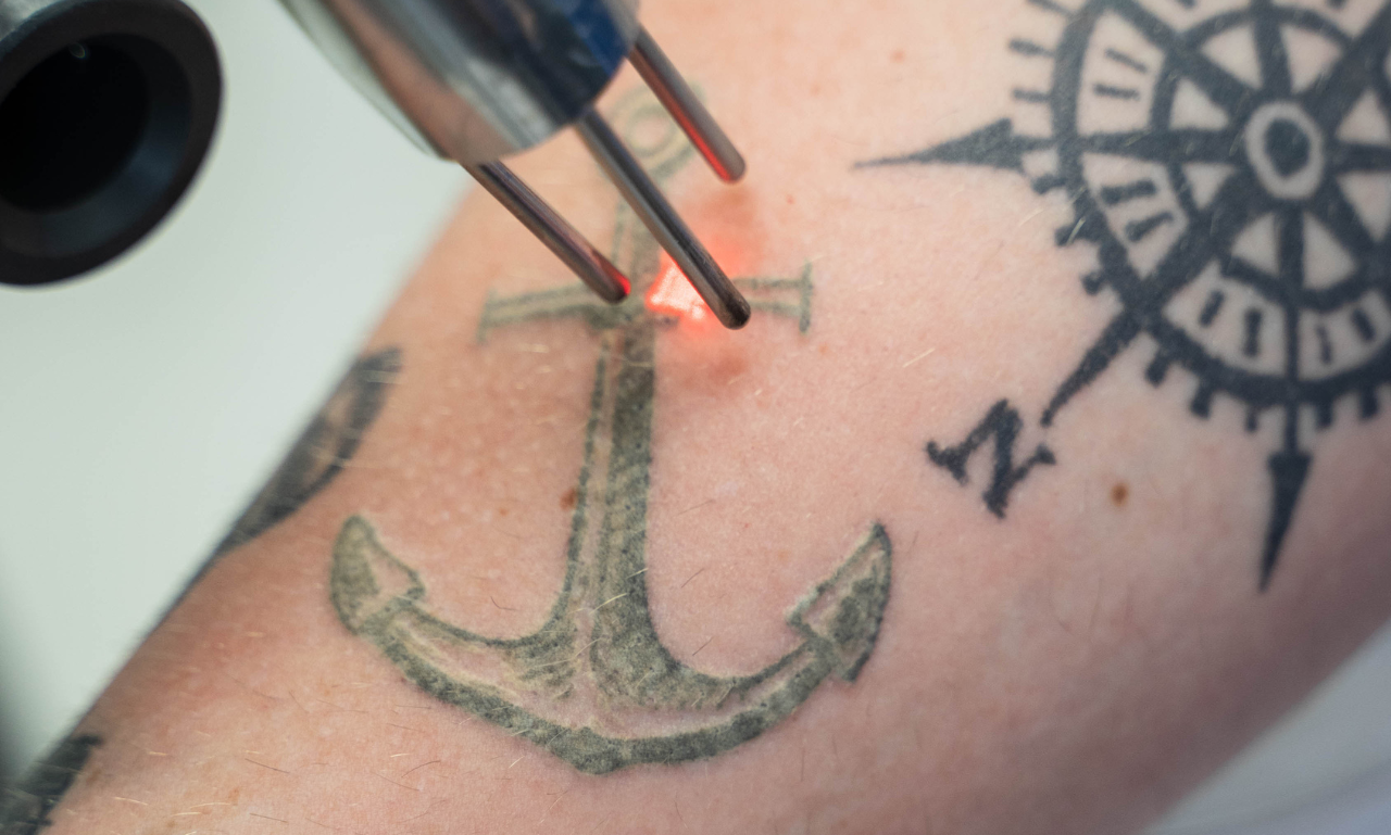 Permanent Make-up Tattoo Removal at BH Laser Tattoo Removal