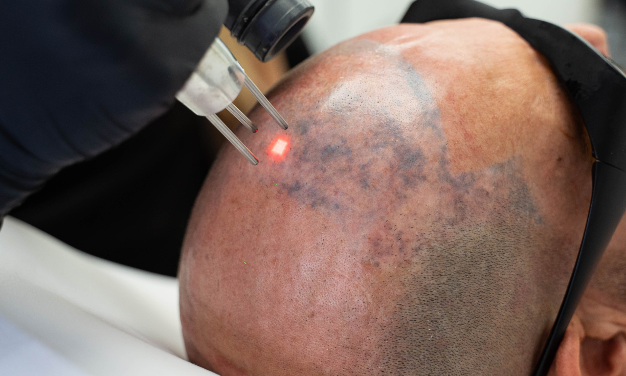 The Truth About Tattoo Removal Scars: Why Our Advanced Technology Makes the Difference